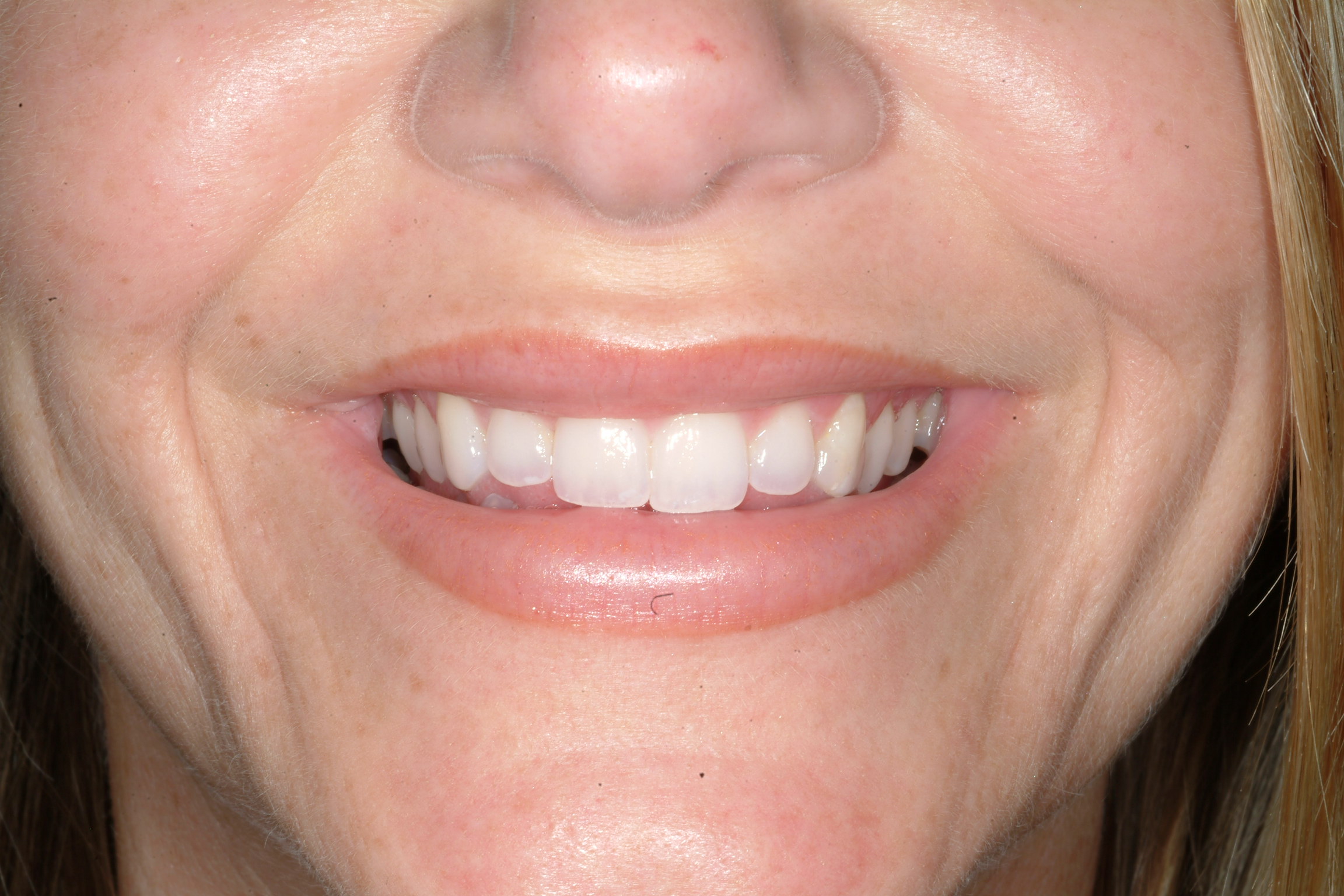 PermaLip Lip Enhancement Lip Augmentation