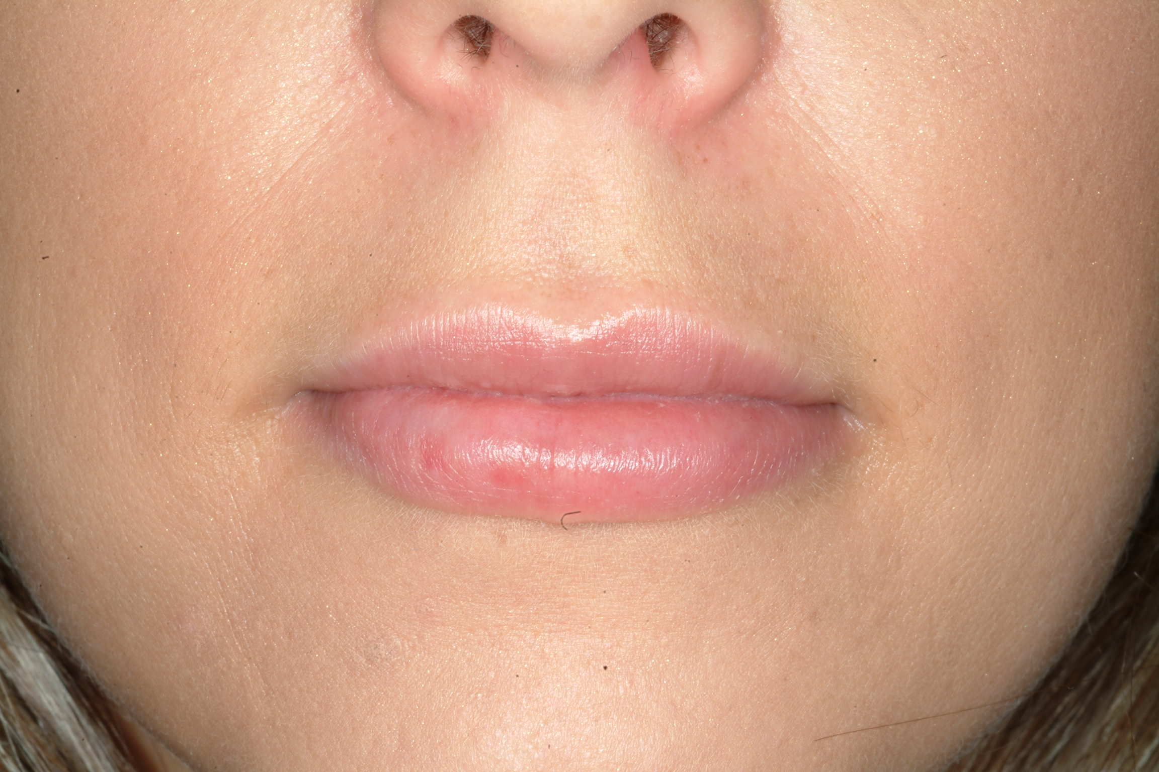 PermaLipLip enhancementLip augmentation